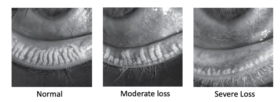 Images depicting the progression of meibomian gland dysfunction